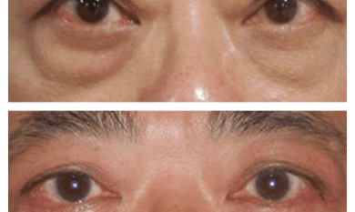 Eye Bag Removal in Dubai