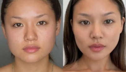 Buccal Fat Removal in Dubai