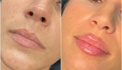 Juvederm in Dubai