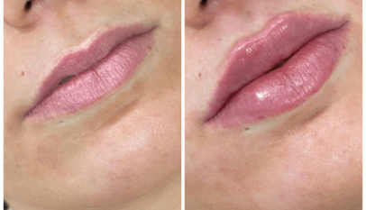 Juvederm in Dubai