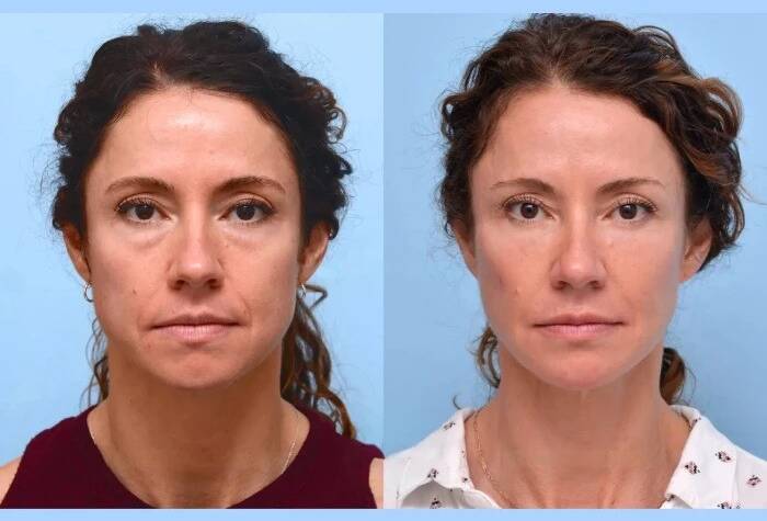 Reveal a Lifted Look with Thread Lift at the Best Aesthetic Clinics in Dubai