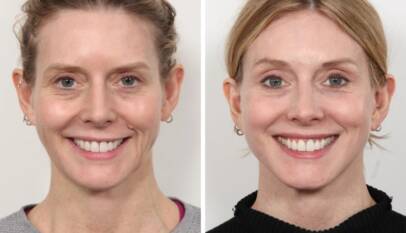 Thread lift in dubai