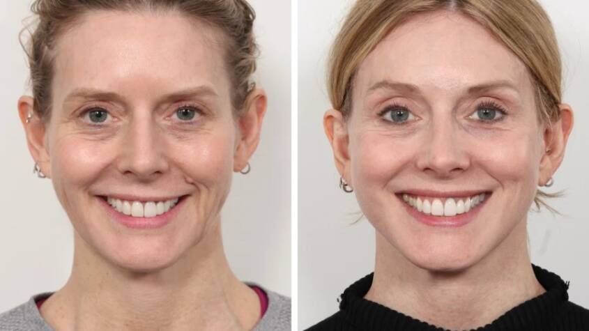 Thread lift in dubai