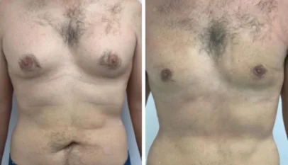 Gynecomastia in Dubai