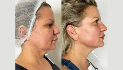Endolift Treatments in Dubai vs Traditional Facelifts: A Modern Comparison
