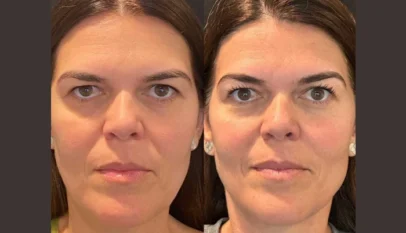 Thread Lift Treatments in Dubai Tightens Skin While Maintaining Natural Expression