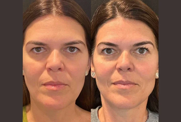 Thread Lift Treatments in Dubai Tightens Skin While Maintaining Natural Expression