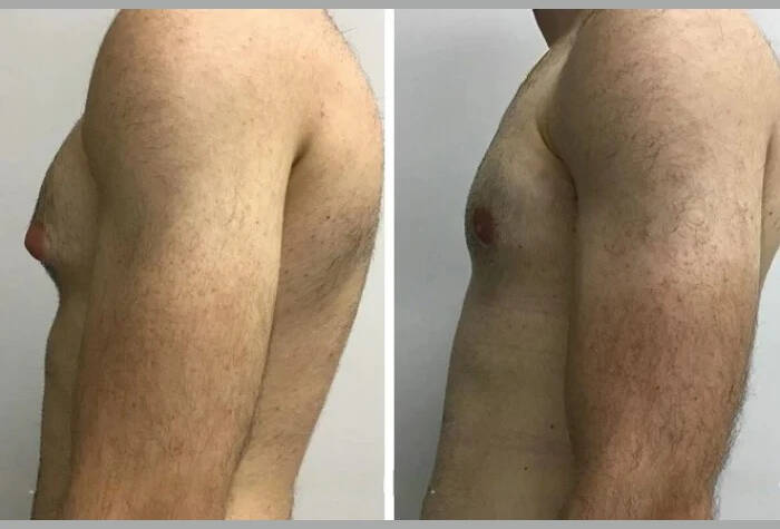 gynecomastia in dubai