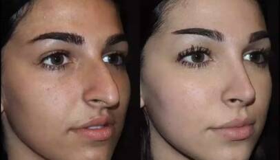 Septoplasty in Dubai