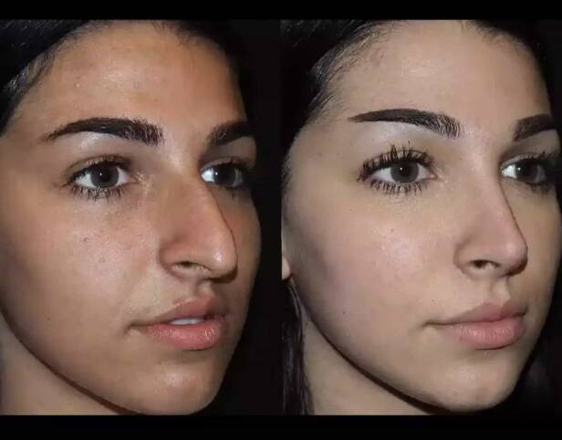 Septoplasty in Dubai