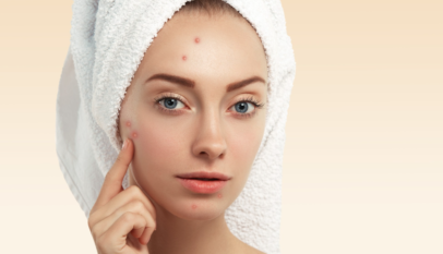 Acne Treatment In Manchester