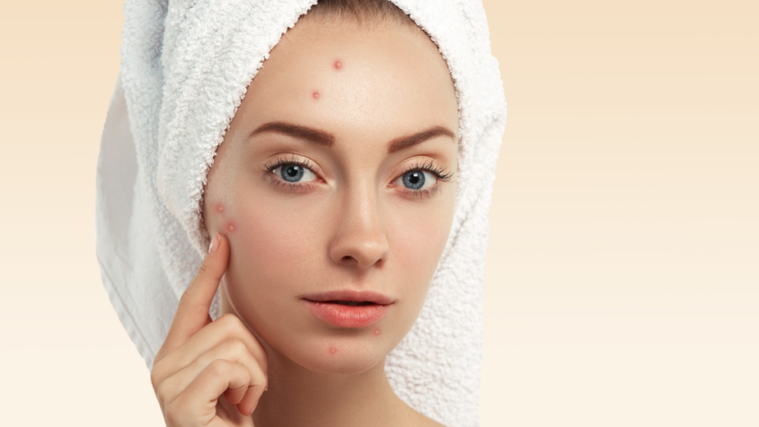 Acne Treatment In Manchester