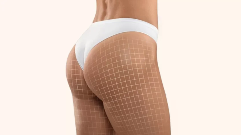 Butt Fat Transfer in Dubai