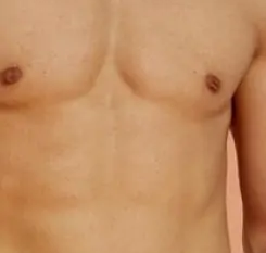 شفط الدهون في جدة