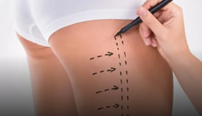 Thigh Liposuction In Dubai