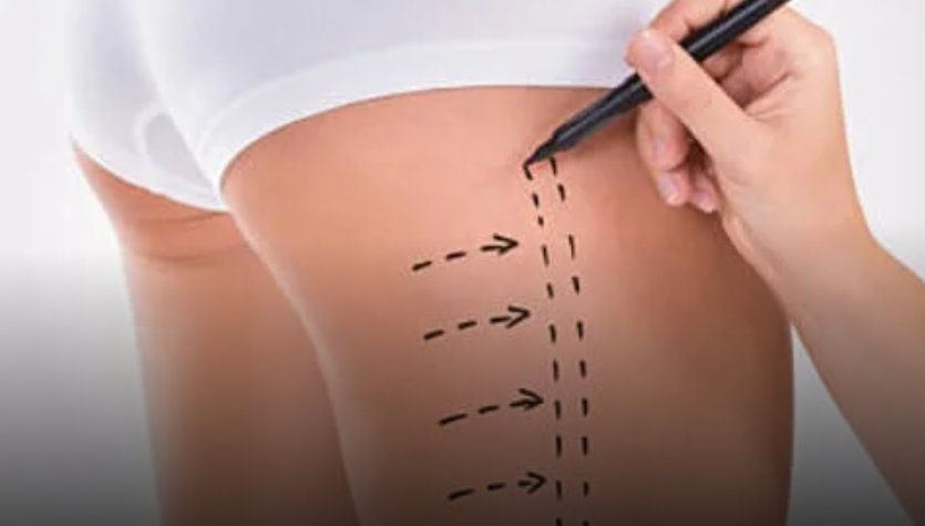 Thigh Liposuction In Dubai