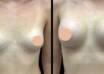 breast augmentation in Dubai