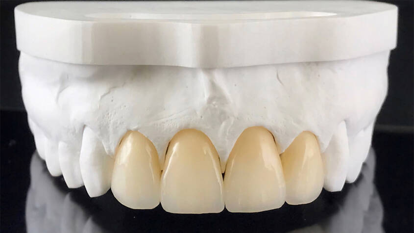 Zirconia Crown Dubai